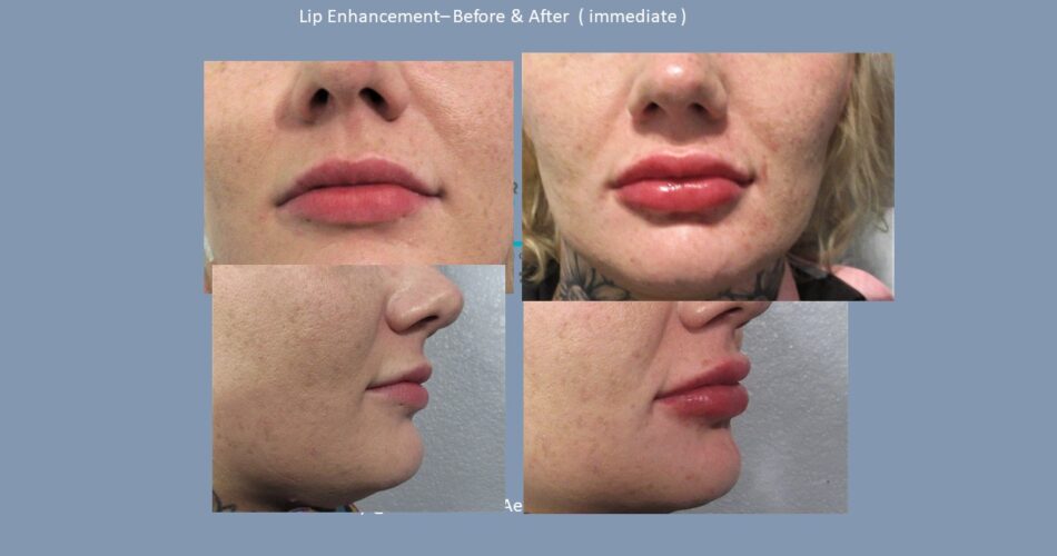 Dr. Ray: Lip Augmentation