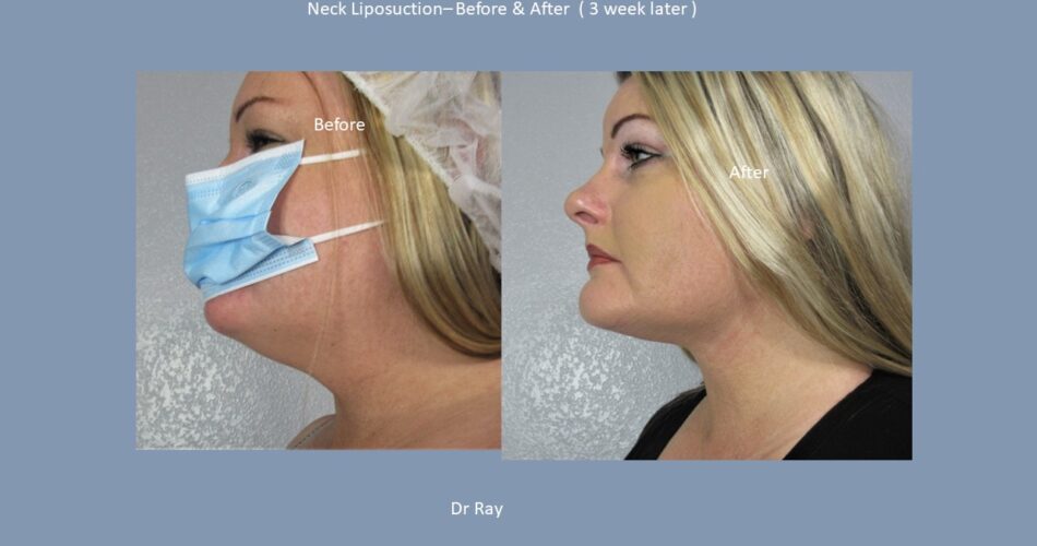 Neck Liposuction By Dr Ray