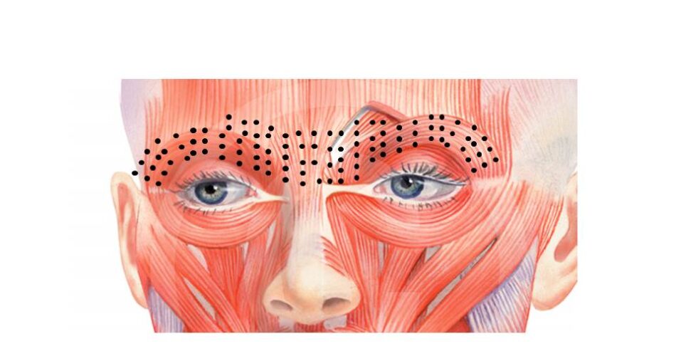 Micro Botox injections