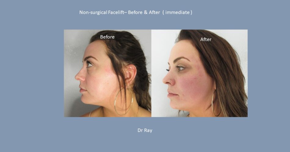 Non-Surgical Facelift